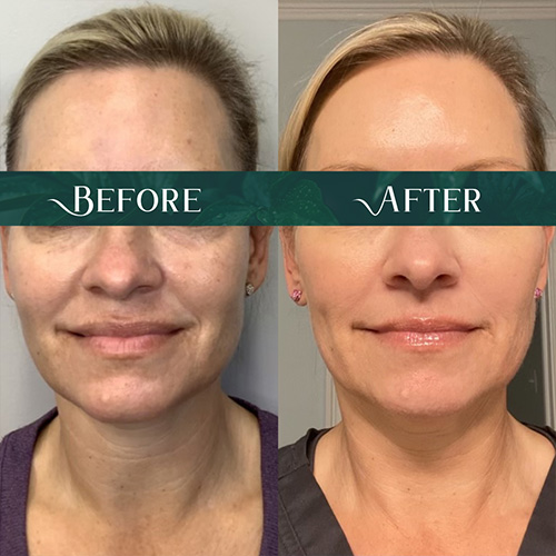 Dermal Fillers Medical Spa Jacksonville Fl Neo Aesthetics Center 